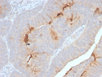 IHC staining of FFPE human colon carcinoma with recombinant SAA antibody. HIER: boil tissue sections