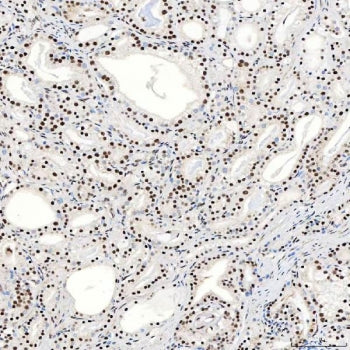 IHC staining of FFPE human prostate adenocarcinoma tissue with SNRNP40 antibody. HIER: boil tissue s