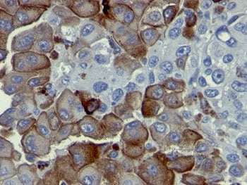 IHC analysis of formalin-fixed, paraffin-embedded human melanoma stained with p75NTR antibody (clone