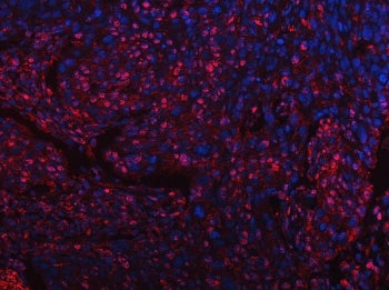 Immunofluorescent staining of FFPE human esophageal squamous carcinoma with Tip110 antibody (red) an