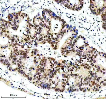 Immunohistochemical staining of ERCC5 using anti-ERCC5 antibody. ERCC5 was detected in a paraffin-em