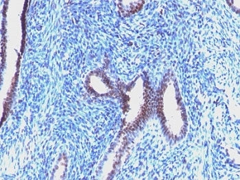 IHC: Formalin-fixed, paraffin-embedded human endometrial carcinoma stained with Cyclin B1 antibody (