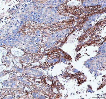 IHC staining of FFPE human esophageal squamous carcinoma tissue with LSG1 antibody. HIER: boil tissu