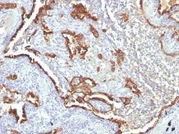 IHC: Formalin-fixed, paraffin-embedded human lung carcinoma stained with Cytokeratin 7 antibody (KRT