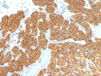 IHC: Formalin-fixed, paraffin-embedded human parathyroid stained with Parathyroid Hormone antibody (