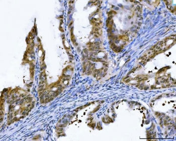 IHC staining of FFPE human ovarian cancer tissue with GST pi antibody. HIER: boil tissue sections in