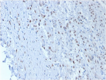IHC testing of FFPE human mesothelioma with Wilms Tumor 1 antibody (clone SPM361). Required HIER: bo