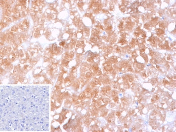 IHC staining of FFPE human hepatocellular carcinoma tissue with CYP2C9 antibody (clone CYP2C9/13121)