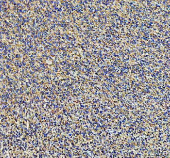 IHC staining of FFPE human glioma tissue with Ephrin Receptor B3 antibody, HRP-secondary and DAB sub