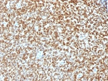 IHC testing of FFPE Ewings sarcoma with recombinant NKX2.2 antibody (clone NX2/1422R). HIER: steam s