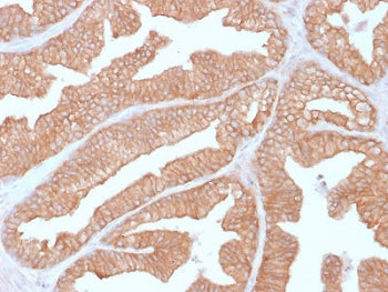 IHC testing of FFPE human prostate carcinoma with Calcineurin antibody (clone CALNA/2353). HIER: boi