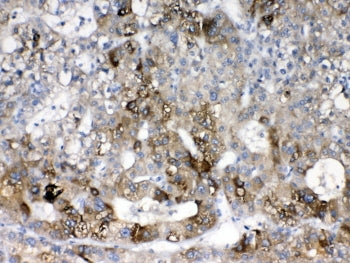 IHC testing of FFPE human liver cancer tissue with CYP2D6 antibody at 1ug/ml. Required HIER: steam s