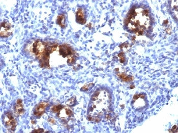 IHC: Formalin-fixed, paraffin-embedded human gastric carcinoma stained with MUC3 antibody (MUC3/1154