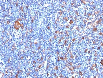IHC: Formalin-fixed, paraffin-embedded human Hodgkin's lymphoma stained with Fascin antibody (clone