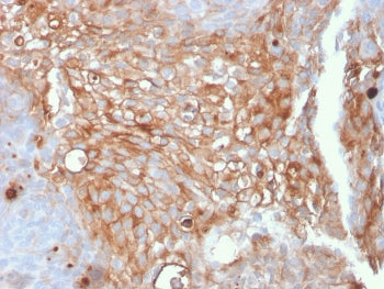 IHC staining of FFPE human urothelial carcinoma with Uroplakin 1A antibody (clone UPK1A/2925). HIER: