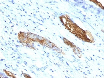 IHC: Formalin-fixed, paraffin-embedded human colon carcinoma stained with Blood Group Antigen A anti