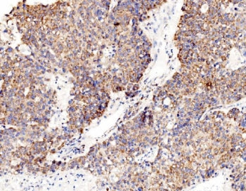 IHC staining of FFPE human liver cancer tissue with RPL8 antibody. HIER: boil tissue sections in pH8