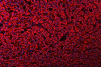 Immunofluorescent staining of FFPE human liver cancer tissue with FRY antibody (red) and DAPI nuclea