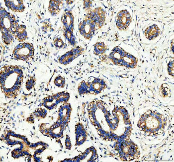 IHC staining of FFPE human breast cancer tissue with WDR1 antibody, HRP-secondary and DAB substrate.