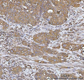 IHC staining of FFPE human appendiceal adenocarcinoma tissue with HO-2 antibody. HIER: boil tissue s