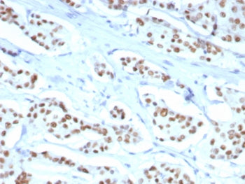 IHC staining of FFPE human breast carcinoma tissue with ER-A antibody (clone ESR1/8407R). HIER: boil