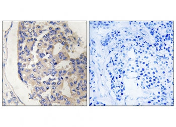 IHC staining of FFPE human breast carcinoma tissue with C1S antibody (left) and without primary antibody (right). HIER: steam section in pH6 citrate buffer for 20 min and allow to cool prior to staining.