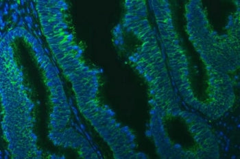 Immunofluorescent staining of FFPE human colon cancer tissue with TXNDC5 antibody (green) and DAPI n