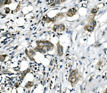 IHC staining of FFPE human breast cancer with RICTOR antibody. HIER: boil tissue sections in pH8 EDT
