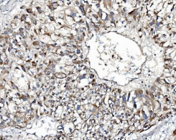 IHC staining of FFPE human liver cancer with Indoleamine 2,3-dioxygenase 2 antibody. HIER: boil tiss