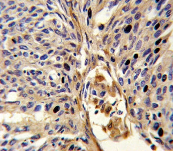 IHC testing of FFPE human lung carcinoma tissue with APEX2 antibody. HIER: steam section in pH6 citr