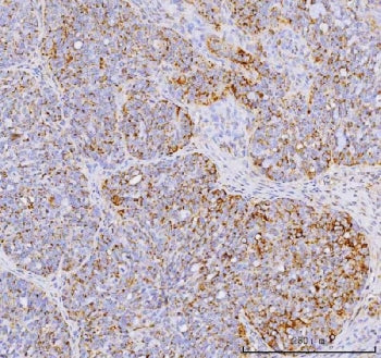 IHC staining of FFPE human ovarian cancer tissue with YB1 antibody. HIER: boil tissue sections in pH