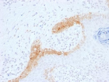 IHC testing of FFPE human basal cell carcinoma with Cytokeratin 15 antibody (clone KRT15/1699). Requ