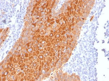 IHC staining of FFPE human squamous cell carcinoma with pan Cytokeratin antibody cocktail (clone Coc