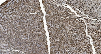 IHC staining of FFPE human lymphoma with Ku70 antibody. HIER: boil tissue sections in pH8 EDTA for 2
