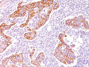 IHC staining of human breast carcinoma with p-Tyr antibody (clone SPM102).