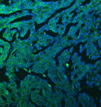 Immunofluorescent staining of FFPE human renal cancer tissue with Sideroflexin-3 antibody (green) an