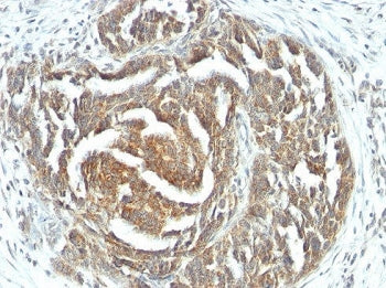 IHC: Formalin-fixed, paraffin-embedded human ovarian carcinoma stained with VEGF antibody (clone VEG