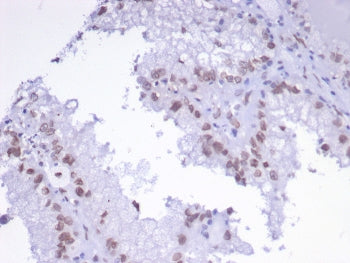 IHC staining of FFPE human renal cell carcinoma tissue with TFAP2A antibody (clone PCRP-TFAP2A-2C2).
