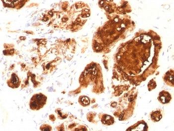 IHC testing of FFPE human ovarian carcinoma with recombinant MUC-1 antibody (clone rMUC1/960). Requi