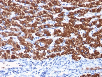 IHC staining of human hepatocellular carcinoma with Hep Par 1 antibody (clone OCH1E5). HIER: boil ti