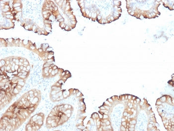 IHC staining of FFPE human colon carcinoma with Villin antibody cocktail (clones VIL1/1314 + VIL1/23
