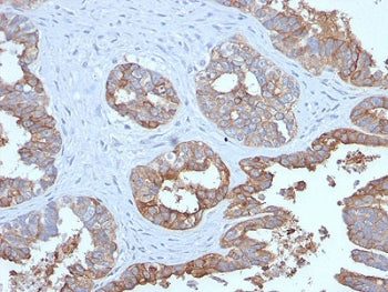 IHC testing of FFPE human prostate carcinoma with recombinant MUC1 antibody. Required HIER: boil tis