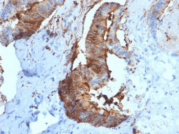 IHC testing of FFPE human renal cell carcinoma with Cathepsin D antibody (clone CTSD/2781). HIER: bo