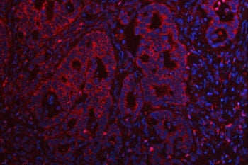 Immunofluorescent staining of FFPE human intestinal cancer tissue with TMEM132B antibody (red) and D