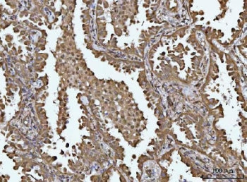IHC staining of FFPE human lung cancer tissue with TIP3 antibody. HIER: boil tissue sections in pH8