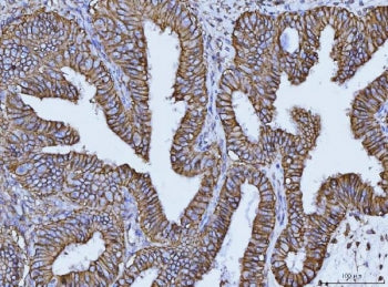 IHC staining of FFPE human endometrial cancer tissue with CD147 antibody. HIER: boil tissue sections