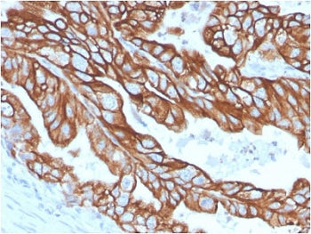 IHC staining of FFPE human colon carinoma with recombinant CK18 antibody (clone KRT18/2808R). Requir