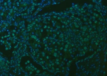 Immunofluorescent staining of FFPE human lung cancer tissue with U2 snRNP A antibody (green) and DAP