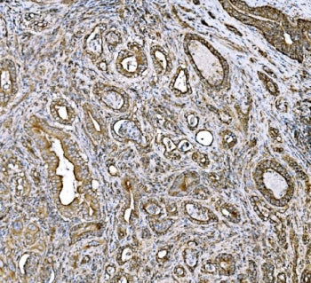 IHC staining of FFPE human liver cancer tissue with DLAT antibody. HIER: boil tissue sections in pH8