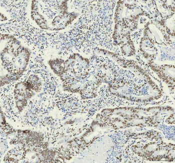 IHC analysis of HNRNPM using anti-HNRNPM antibody. HNRNPM was detected in a paraffin-embedded sectio
